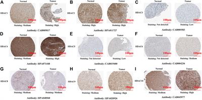 Comprehensive Analysis of the Differential Expression and Prognostic Value of Histone Deacetylases in Glioma